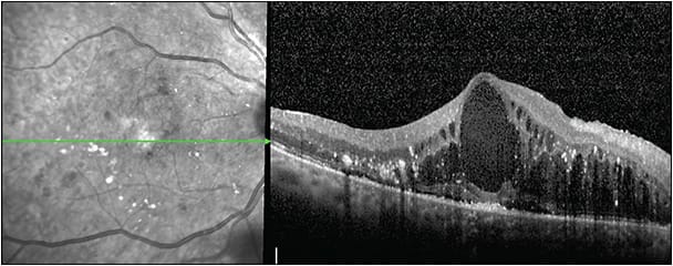Figure 1. Optical coherence tomography showing diabetic macular edema.