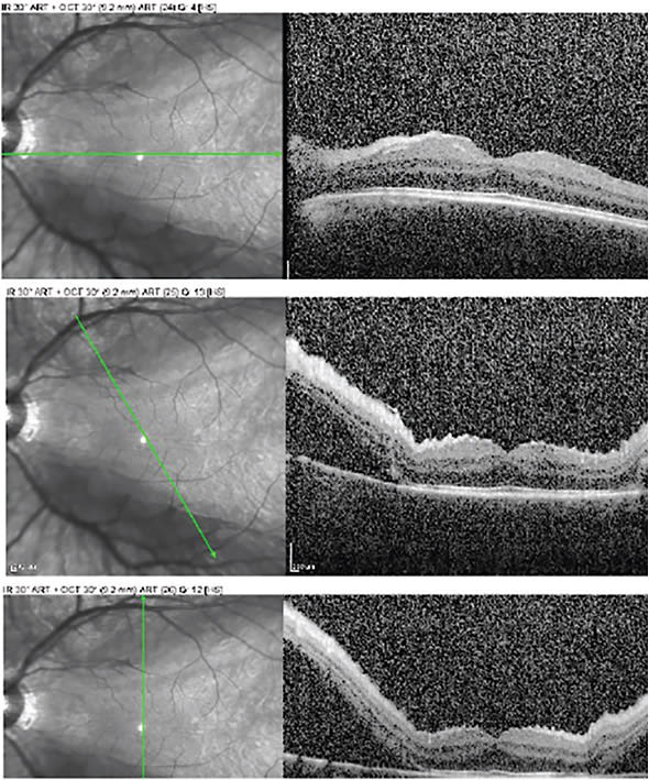 Figure 2. Fovea-sparing macula-off rhegmatogenous superior and inferior rhegmatogenous retinal detachment. Patient presented with acute peripheral vision loss and a best-corrected visual acuity of 20/25. While OCT imaging of the macula shows that the fovea is attached, there is significant subretinal fluid superior and inferior to the attached fovea.
