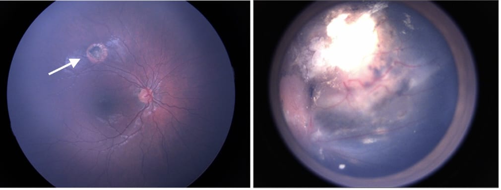 In a patient whose retinoblastoma stems from maternal inheritance, left, there is only a small tumor in the eye (denoted by white arrow) that responded well to treatment. Comparatively, in a patient with paternal inheritance, an extensive tumor burden affects underlying retinal structures. Image courtesy of Dr. Debarshi Mustafi