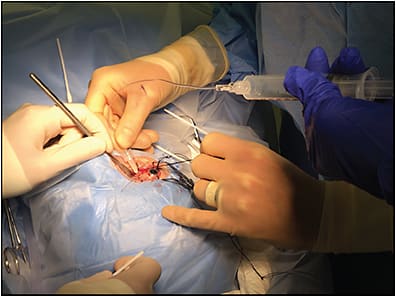 Figure 1. Transscleral biopsy. The unscrubbed assistant (blue gloves) pulls back on the syringe with the needle engaged in the tumor to create suction.