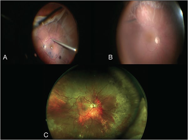 Figure 1.  Intraoperative fundus image during the first surgery (A); intraoperative fundus image during HSO removal (B); fundus image 2 months after surgery (C).