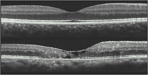 Figure 2. This spectral-domain optical coherence tomography (OCT) image shows the typical findings in individuals with macular telangiectasia type 2. The upper image shows the normal OCT and the lower image shows the typical cavitations seen in the inner and outer retina and the disruption of the ellipsoid zone.