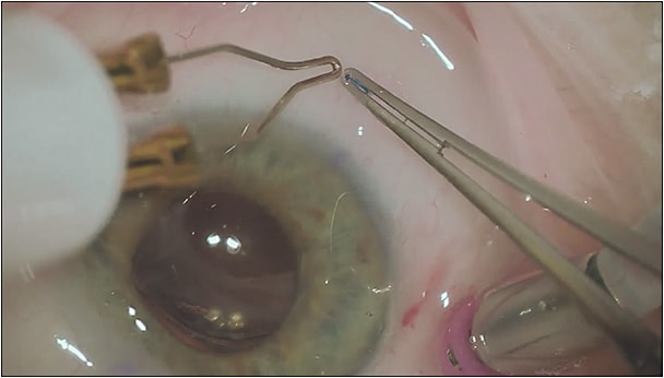Figure 3. Flanged IOL fixation. Following externalization of the leading and trailing haptics, low-temperature cautery is used to create a bulb, or “flange,” of the distal haptic end. The flange is then reposited within the scleral tunnel tract to reduce the risk of haptic slippage. Note that the cautery does not directly touch the haptic, but rather is held a close distance away.
IMAGE COURTESY YOSHIHIRO YONEKAWA, MD