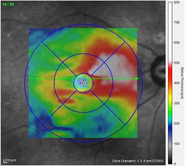 Figure 6. The vision of a patient with chronic serous chorioretinopathy improved from 20/200 to 20/140 after microsecond pulsing laser treatment.