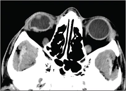 Figure 2. Computed tomography scan of orbits shows an axial image of an irregular right globe with a full-thickness scleral laceration.