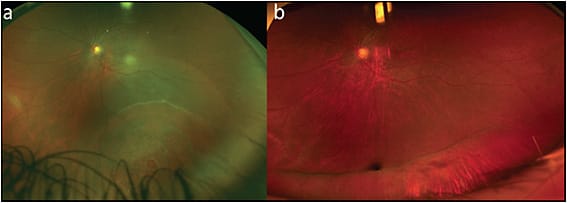 Figure 2. A 38-year-old female who was 29 weeks pregnant presented with inferior fovea-sparing retinal detachment in the left eye associated with multiple localized holes inferiorly (A). Subretinal fluid encroached just inferior to the fovea, with intraretinal fluid involving the fovea with 20/20 acuity with subjective distortion. She underwent placement of a 506 sponge with cryotherapy. She experienced slow improvement in fluid postoperatively with subjective improvement and 20/20 acuity (B) (no drainage performed).