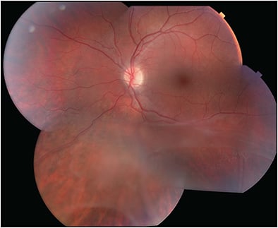 Figure 3. Imaging of a 12-year-old patient with X-linked retinoschisis with a family history of RS1 mutation. This patient has peripheral schisis but no evidence of macular schisms by OCT.