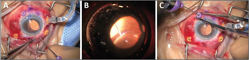 Figure 4. When rescuing an intraocular lens, use retina forceps through the cannula to grasp the haptic tip and externalize (can start either inferiorly or superiorly) (A). With the superior haptic externalized here, use the indirect viewing system to then grasp the inferior haptic tip (B). Pull out with the retina forceps until resistance is met at the internal mouth of the cannula and then elevate the cannula along the forceps shaft as shown here before externalizing (C).