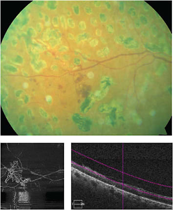 Figure 2
Images courtesy of Shannon Leon, OD, Joseph J. Pizzimenti, OD, Kirsti Ramirez, OD, and Carolyn Majcher, OD