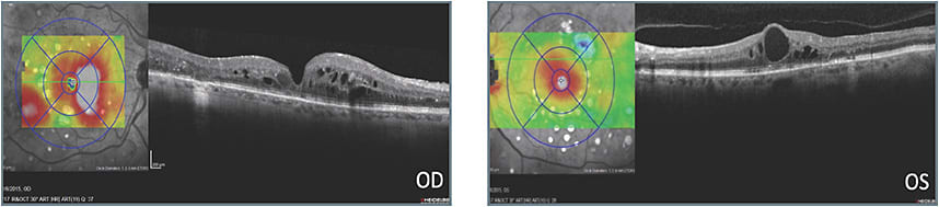A: OCT prior to treatment by current physician