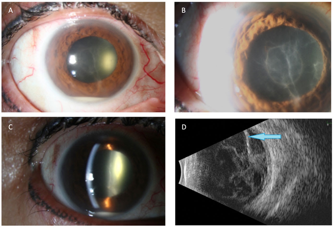 <p><strong>Figure 1. </strong>Typical signs of endophthalmitis include (A) hypopyon, (B) fibrin, (C) anterior vitreous cell, and (D) prominent vitreous opacities<span class="Apple-converted-space">&amp;nbsp; </span>and membrane formation (arrow) on B-scan ultrasonography. <em>Images courtesy Harry W. Flynn Jr, MD.</em></p>