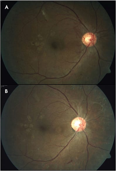 Figure 2. Pre-anti-VEGF (A) and post anti-VEGF (B) fundus color photos show significant regression of new vessels of the disc after 3 consecutive anti-VEGF injections. Additional anti-VEGF is recommended for this eye until proliferative diabetic retinopathy fully regresses or until the neovascularization remains stable for 3 consecutive visits.