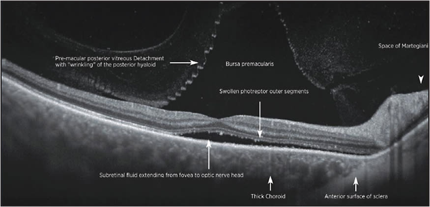 Figure 7. SS-OCT of CSR demonstrating details of vitreoretinal interface, retinal layers, and choroid.
IMAGE COURTESY PROF. P.E. STANGA, MANCHESTER ROYAL EYE HOSPITAL, MANCHESTER VISION REGENERATION LAB AT NIRH,  WELCOME TRUST MANCHESTER CRF, UNIVERSITY OF MANCHESTER, MANCHESTER, UK.