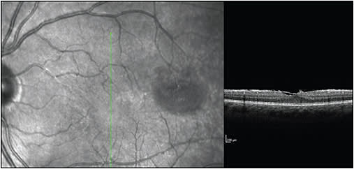 Figure 2. Epiretinal membrane, left eye.
