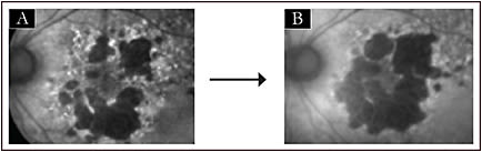 Figure 4. Progression of geographic atrophy from baseline (A) to 12 months (B), as shown by fundus autofluorescence in an eye being treated for neovascular age-related macular degeneration with anti–vascular endothelial growth factor therapy
Images courtesy of Carl D. Regillo, MD, FACS