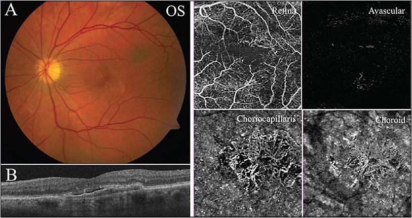 Figure 2. An 80-year-old white male with nAMD. Fundus photo of OS demonstrates pigmentary changes within the macula along with superotemporal choroidal nevus. BCVA was 20/50 OS (A). SD-OCT of OS shows a fibrovascular PED and subretinal fluid (B). OCT angiography en face projection image of the neovascular membrane (C) demonstrates abnormal vascular flow patterns within the choriocapillaris (bottom left) and choroid (bottom right) slabs; however, minimal irregularities are observed in the avascular (top right) or full thickness retina (top left) slabs.
