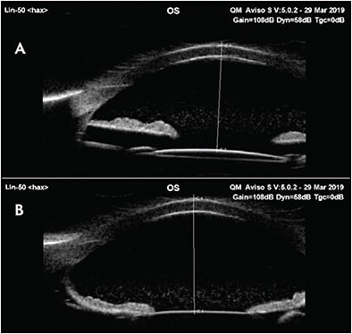 Figure 4. Intermittent reverse pupillary block (A) and iris touch (B) on ultrasound biomicroscopy in an eye with Marfan syndrome with scleral-sutured intraocular lens.
