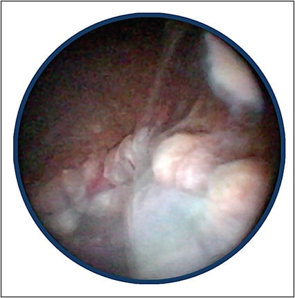 Figure 1. Endoscopic image reveals purulent material extending to the optic nerve in an eye with endophthalmitis. Visualization using the wide-angle viewing system was not possible due to corneal abscess and edema.