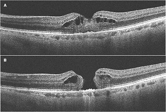 Figure 1. (A) The scan was acquired through the patient’s subjective fixation, giving the appearance of intraretinal fluid. (B)The imager moves the scan to the patient’s fovea, and a full thickness macular hole is revealed.