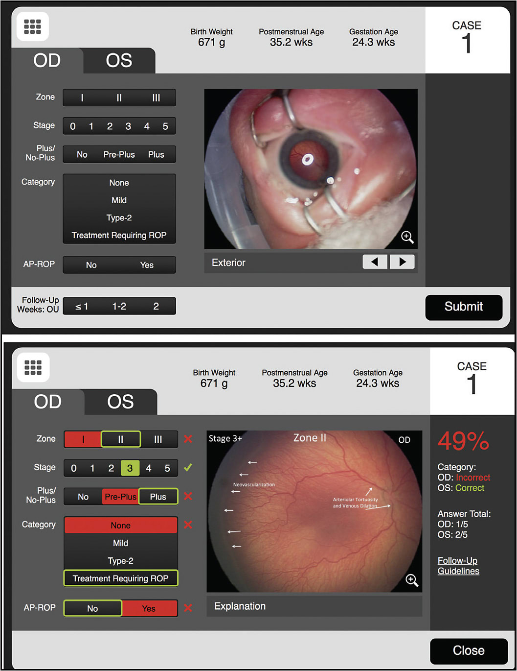 Figure 3.  Case-based retinopathy of prematurity learning available through the American Academy of Ophthalmology website.
Image copyright the American Academy of Ophthalmology; reprinted with permission.