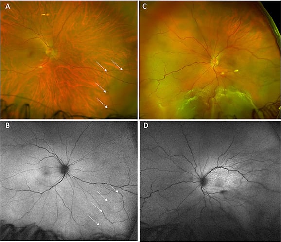 Figure 1. Widefield imaging of a 41-year-old male with decreased vision in the left eye. Nasal localized rhegmatogenous retinal detachment in the right (asymptomatic) eye outlined by arrows (A). Autofluorescence imaging showed subtle area of hyperautofluorescence corresponding to the rhegmatogenous retinal detachment (B). Total rhegmatogenous retinal detachment in the left (symptomatic) eye (C). Corresponding autofluorescence imaging of the total rhegmatogenous retinal detachment (D).