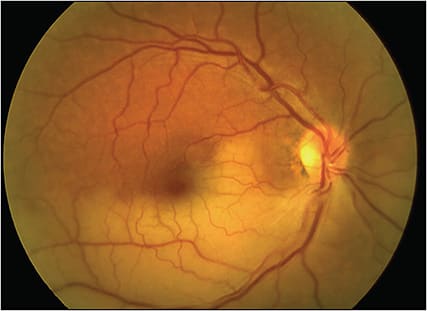 Figure 1. Branch retinal artery occlusion (BRAO). This patient experienced a sudden painless loss of superior and temporal visual field in the right eye, associated with an inferotemporal BRAO due to the embolus seen in the inferotemporal branch retinal artery in this case.