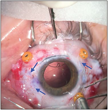 Figure 8. Insertion of the IOL. Note that 9-0 prolene suture is threaded through the inferior eyelet of the IOL and exits through the 9 o’clock sclerotomies. The blue arrows show the 9-0 prolene sutures exiting from the sclerotomies.