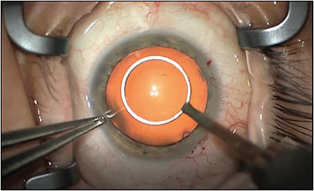 Figure 2. A patient with cataract and epiretinal membrane. Use of a corneal marker can guide capsulorrhexis formation. A smaller capsulorrhexis is generally preferred in combined surgery to prevent anterior prolapse of the intraocular lens.