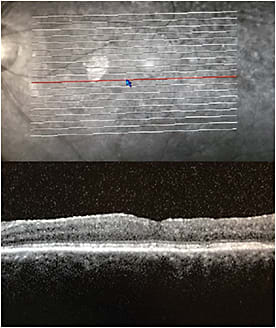 Figure 3. One week after Iluvien was implanted OS, retinal anatomy had normalized, VA had improved to 20/40-1, and intraocular pressure remained unchanged at 14 mmHg.