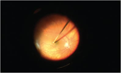 Figure 2. Transvitreal cutter biopsy. The port of a 27-g vitreous cutter approaches a macular melanoma. Once the port is pushed under the retina and into the tumor, the foot pedal is depressed to full aspiration with a cut rate of 150cpm to 200 cpm.