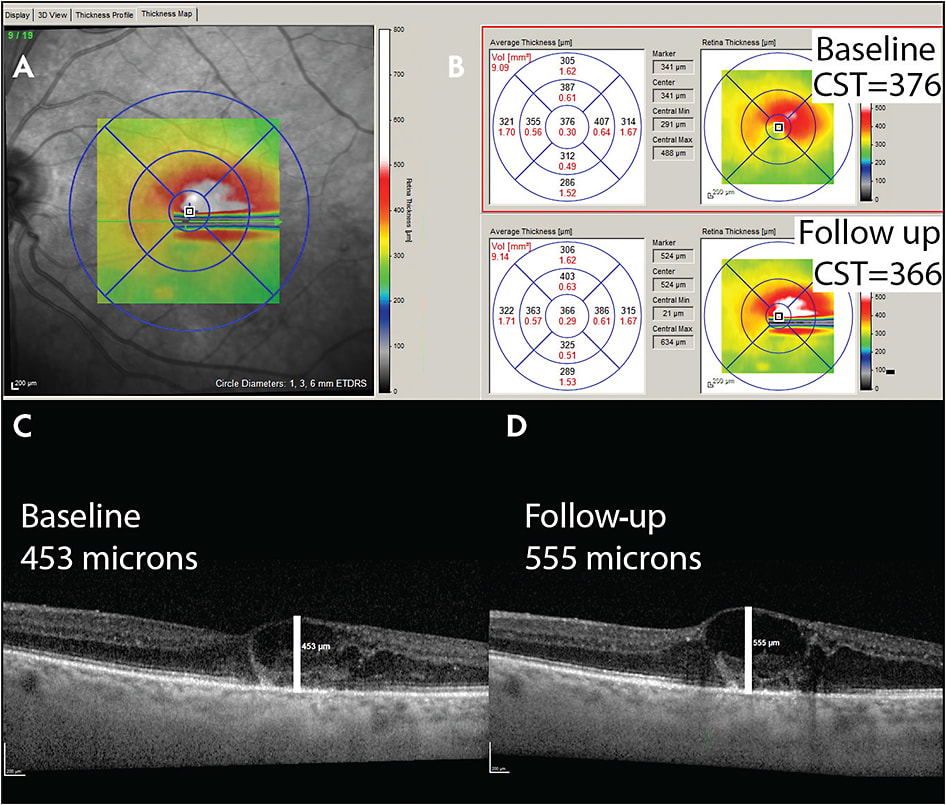 Figure 1. Example of a segmentation error through a single B-scan causing an incorrect CST measurement. Thickness map for the current visit is shown with an ETDRS grid overlay (A). Baseline (top) and follow-up (bottom) thickness maps show values for each ETDRS zone. The CST of 366 microns for the follow-up visit is less than the baseline value of 376 microns, suggesting a small improvement (B). Manual measurements of the maximal retinal thickness show the follow-up visit is more than 100 microns thicker (C, D).
