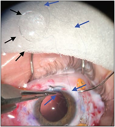 Figure 6. Threading the trailing end of the second 9-0 Prolene suture into the suture passer. The passer will be withdrawn, pulling the suture out through the sclerotomy. The blue arrows show the second suture threaded through the superior haptic eyelet on the IOL and the 2 sclerotomies at the 3 o’clock position. The black arrows show the first 9-0 Prolene suture already threaded through the inferior IOL eyelet and the 2 sclerotomies at the 3 o’clock position.