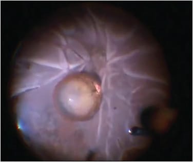 Figure 2. Posteriorly dislocated whole crystalline lens in the setting of a rhegmatogenous retinal detachment.
IMAGE COURTESY QURAISH GHADIALI, MD, AND YASHA MODI, MD