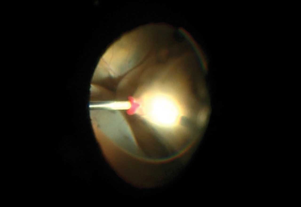 Figure 3. Fine needle aspiration biopsy of a choroidal tumor following visualization after mature cataract extraction.
