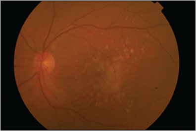 Figure 1. Color fundus photography of an eye affected by intermediate age-related macular degeneration. Intermediate and large drusen are visible at the posterior pole. In the macular region, some drusen are confluent and pigmentary alterations are evident.