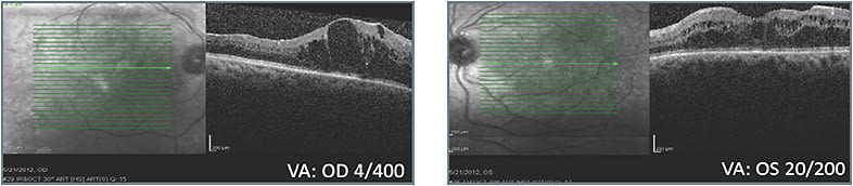 A: Status post 6 treatments with initial therapy