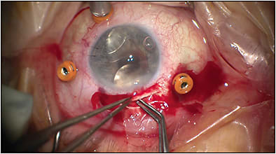 Figure 2. Insertion of anterior-chamber intraocular lens through a scleral tunnel.