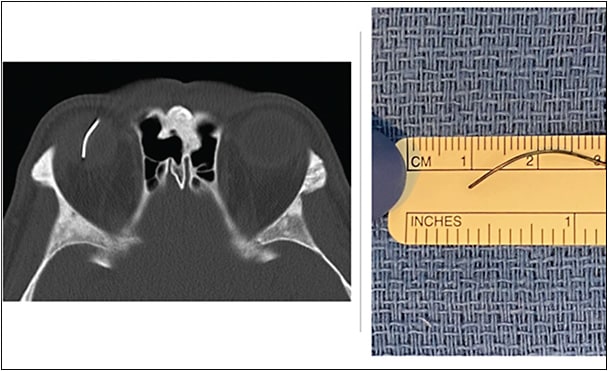 Figure 3. Penetrating injury of the right globe with a retained metallic intraocular foreign body seen on the CT of the orbits.