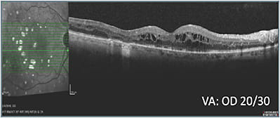 D: Status 20 weeks after treatment class switch OD