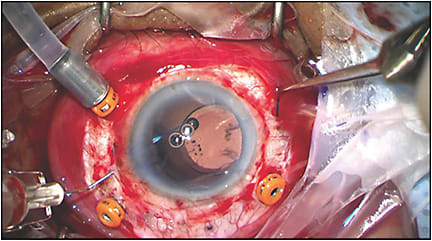 Figure 2. Double-needle intrascleral fixation: the Yamane technique. The haptic of an Aaren Scientific EC-3 PAL is “docked” within the lumen of a 30-gauge TSK needle. In this case, a 20-gauge fragmatome was utilized for removal of retained lens material prior to intrascleral fixation of the IOL. The technique can be performed utilizing limited conjunctival peritomies or via a transconjunctival approach. 
IMAGE COURTESY DILRAJ GREWAL, MD