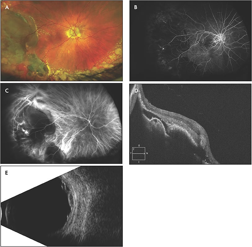 Figure 2. Fundus photograph of the right eye showing multilobulated pigmented and nonpigmented retinal lesions, the largest located inferotemporally, and another lesion located inferiorly with pigmented hemorrhage and associated drusen (A). Fluorescein angiography (FA) of the right eye shows early blockage in the areas of the hemorrhagic pigment epithelial detachments (PEDs), but also one focus of hyperfluorescence (B). Indocyanine green showed early hypocyanescence in the areas of peripheral serosanguinous PED with an area of hypercyanescence in a choroidal polyp-like telangiectasia that corresponds to the hyperfluorescence seen on FA (C). Optical coherence tomography imaging through the temporal lesion reveals a PED with overlying hemorrhage and subretinal fluid (D). B-scan imaging shows multiple subretinal lobulated lesions (E).