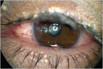 Figure 2. Slit lamp photo demonstrating iris transillumination defect and traumatic cataract.