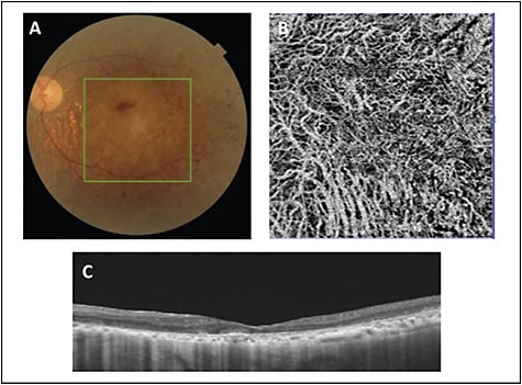 Figure 4. A fundus photo of a case of retinitis pigmentosa (RP) (A). Optical coherence tomography angiography images (Triton; Topcon) show loss of choriocapillaris with visible medium and large choroidal vessels (B). Structural OCT B scan (C) showing choroidal thinning and loss of ellipsoid zone.