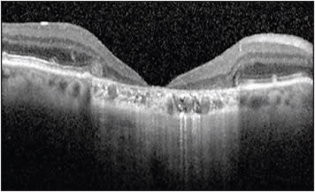 Figure 3. Optical coherence tomography from a patient with GA and severe foveal atrophy resembling a macular hole.