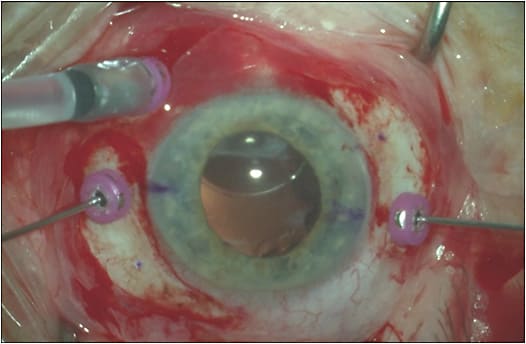 Figure 1. Sclerotomy site positioning in preparation of Gore-Tex sutured PCIOL placement. Utilizing 27-guage instrumentation, 4 sclerotomy sites have been marked (2 nasal, 2 temporal). Each pair of sclerotomies is located 3 mm posterior to the limbus and 5 mm apart. Trocar cannulas are placed in 2 of the sclerotomy sites to perform PPV. An inferiorly dislocated IOL is noted in the pupillary axis. 
IMAGE COURTESY M. ALI KHAN, MD