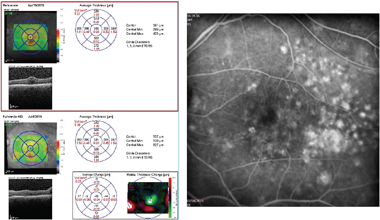 Figure 1. Three months after a second dexamethasone intravitreal implant OS, the effects of the implant on the DME were waning.