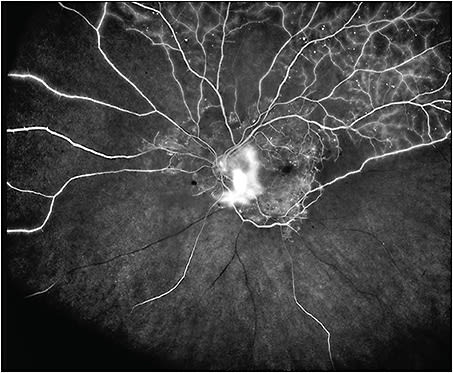 Figure 1. Asymmetric ultrawidefield fluorescein angiogram (Optos California) of a 54-year-old male with proliferative diabetic retinopathy demonstrating widespread nonperfusion and neovascularization.