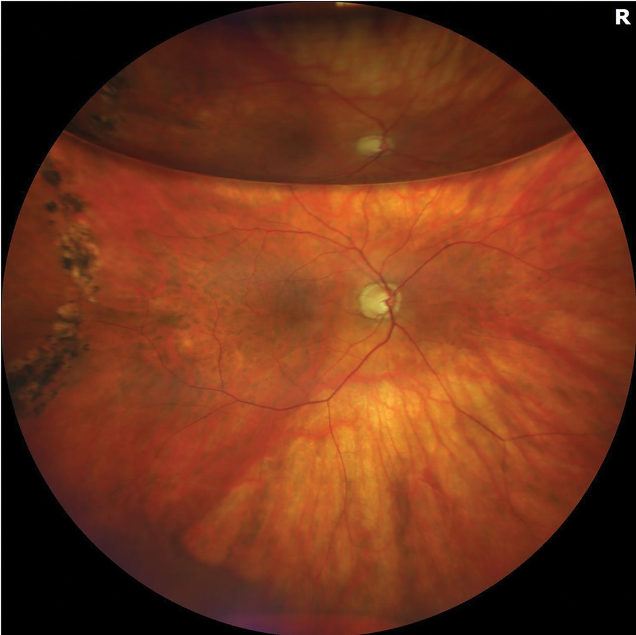 <p><strong>Figure 1.</strong> Rhegmatogenous retinal detachment successfully repaired using pars plana vitrectomy with air tamponade.<em> Image courtesy Trent Chiang, MD, and Geoffrey G. Emerson, MD, PhD, FASRS. </em></p>