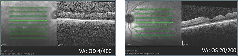 D: Status 1 month after third treatment with different class of therapy
