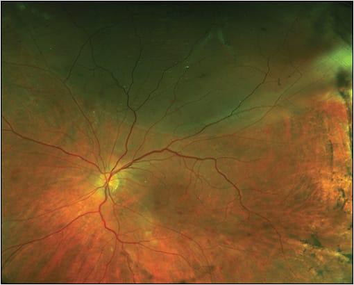 Figure 2. Fundus photograph of delayed-onset retinal detachment in the setting of postoperative Streptococcus intermedius endophthalmitis.
